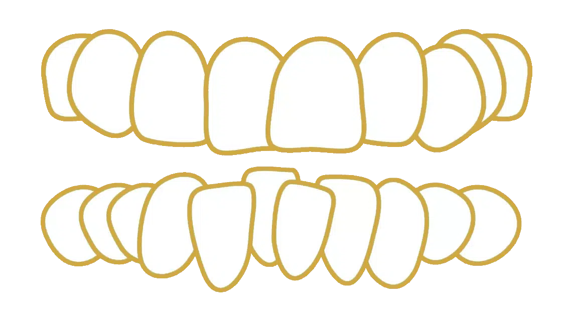 Overlappende tanden